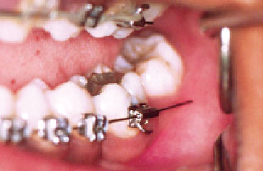 What to do when I have an orthodontic wire sticking out and poking the gums?